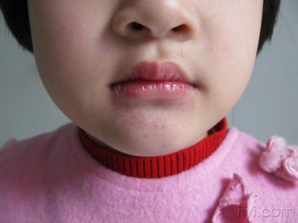 小女孩口唇皮疹--血管内压增高性紫癜
