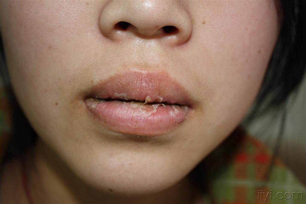 困扰女孩的唇炎.3年 南京 上海各大医院都看过