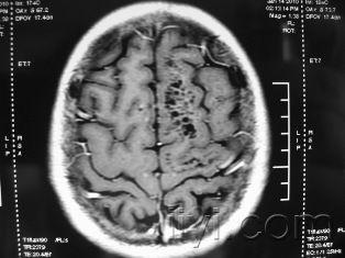 发一疑难病例:左侧大脑半球及胼胝体多发囊性灶,性质?