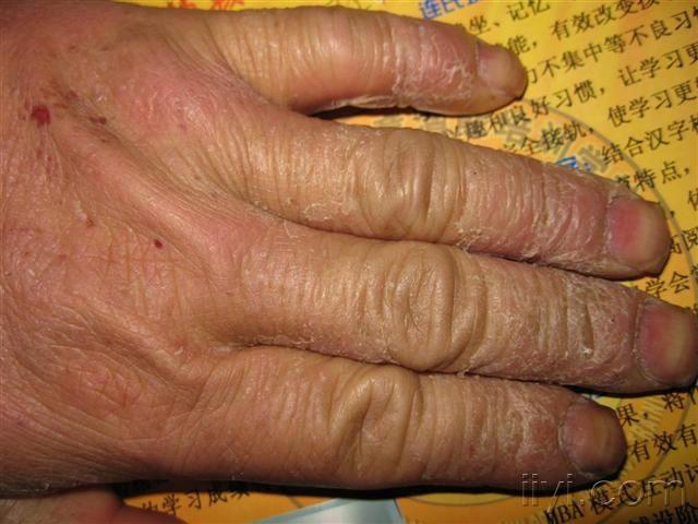 接触性皮炎