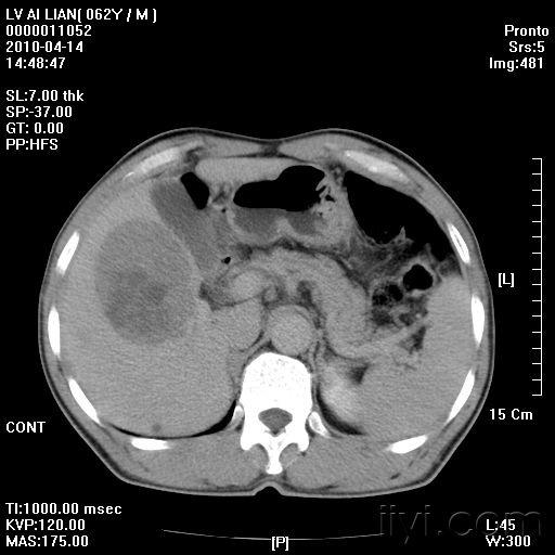 肝脏占位,ct增强,有结果.
