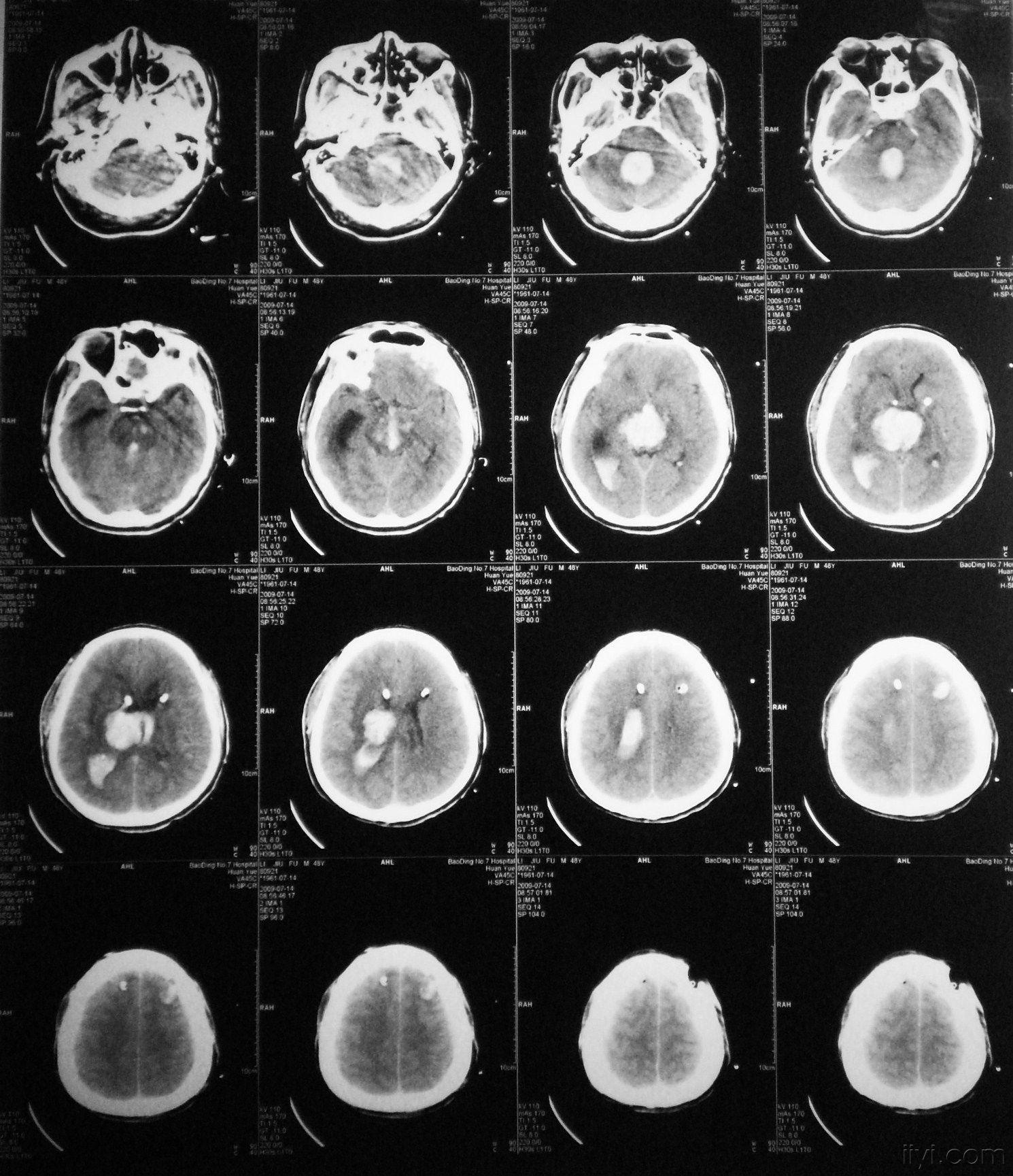我也发一例丘脑出血破入脑室治疗失败的病例.大家指教
