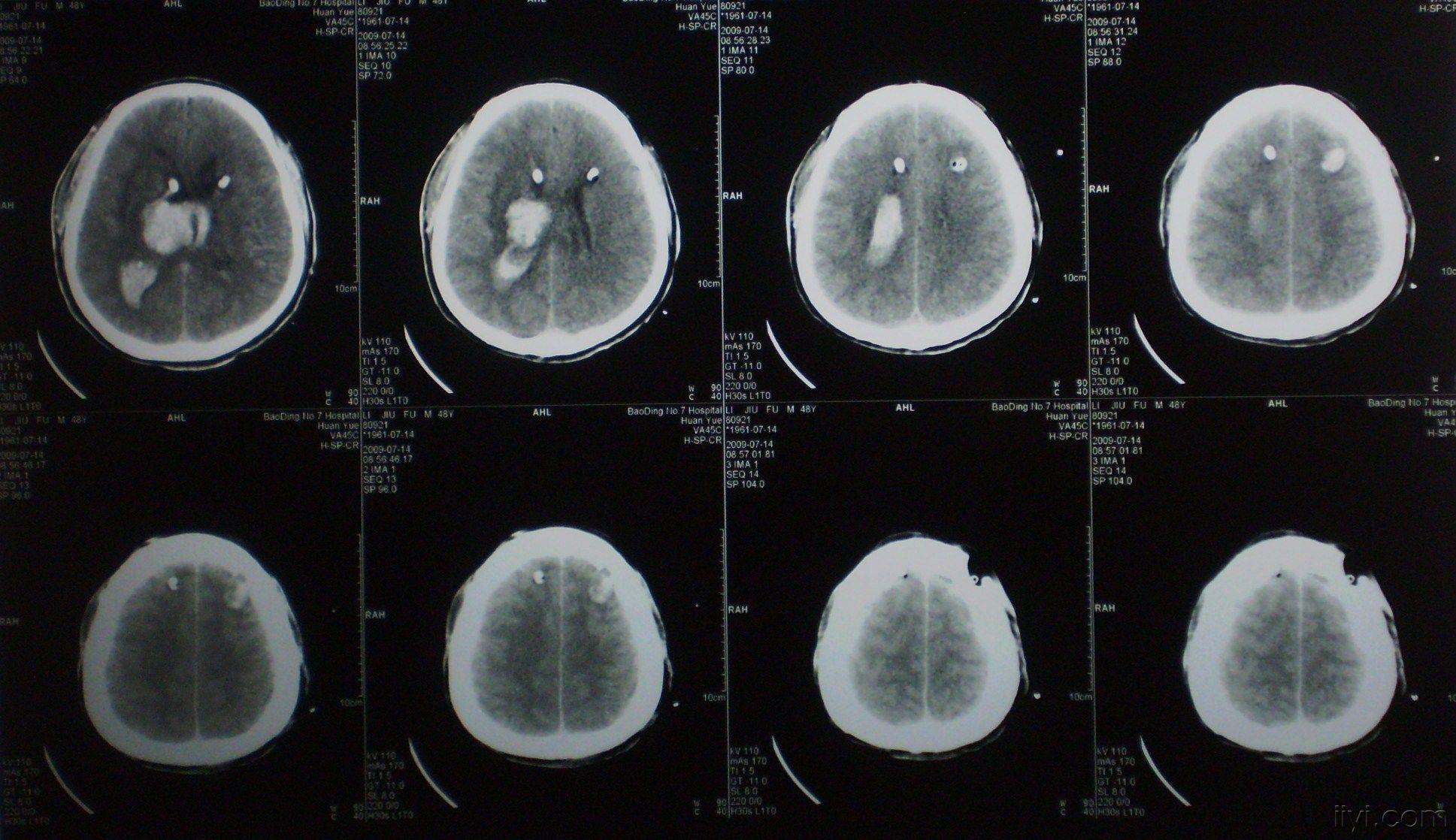 我也发一例丘脑出血破入脑室治疗失败的病例.大家指教