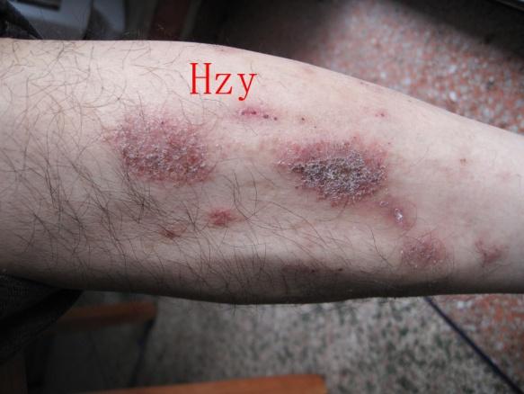 两下肢对称皮损一个月.公布答案:湿疹