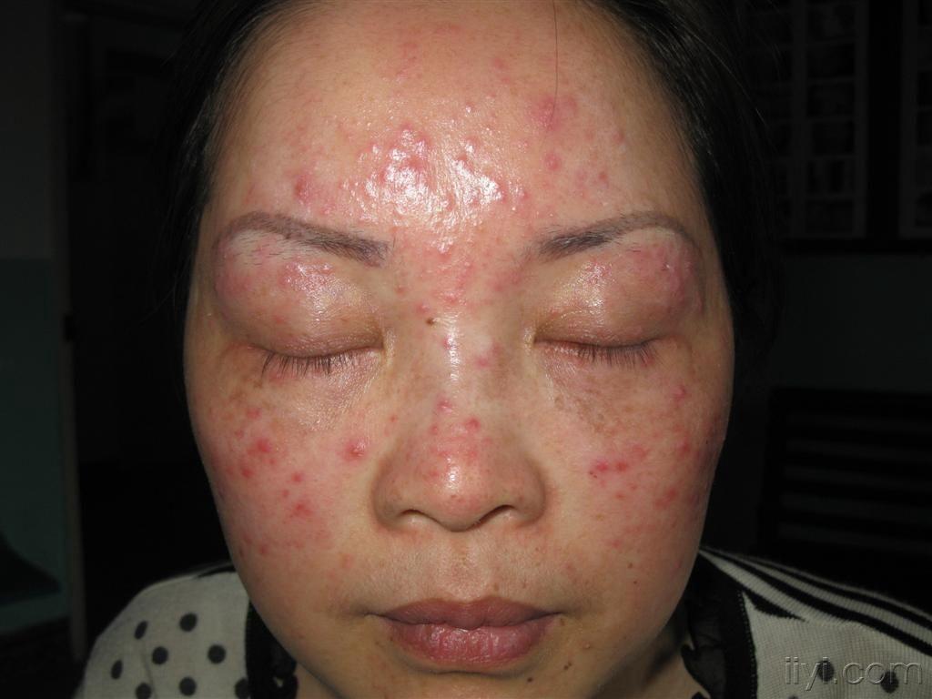 看图识病-颜面播散性粟粒性狼疮