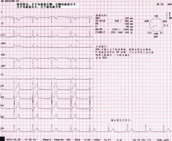 这份图如果用右位心无法解释胸导联心电图,如果用左右手反接,又不是