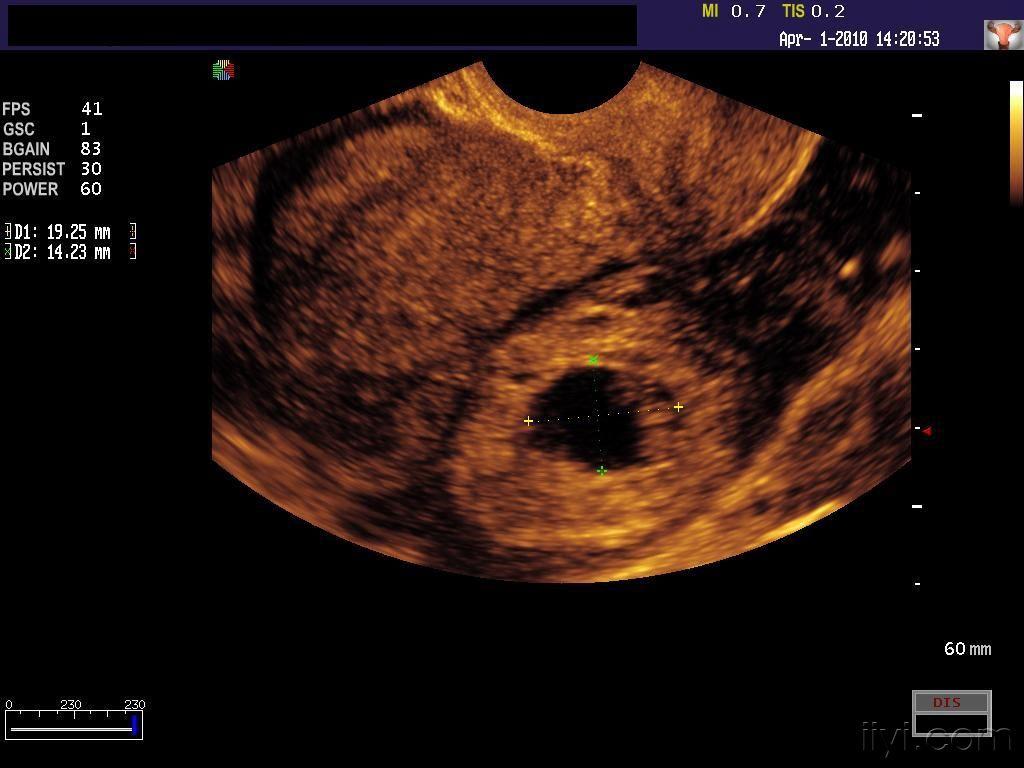 左侧宫外孕 - 超声医学讨论版 - 爱爱医医学论坛 - 医