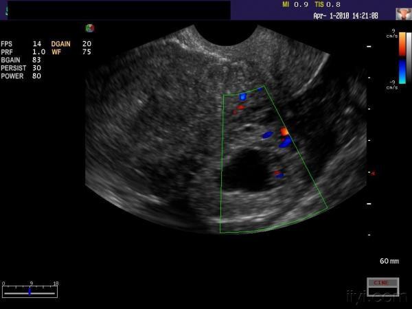 左侧宫外孕 超声医学讨论版 爱爱医医学论坛 爱爱医医学网
