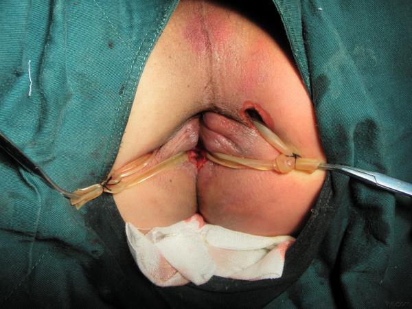 肛周脓肿切开引流手术图片分享 _ 肛肠外科讨论