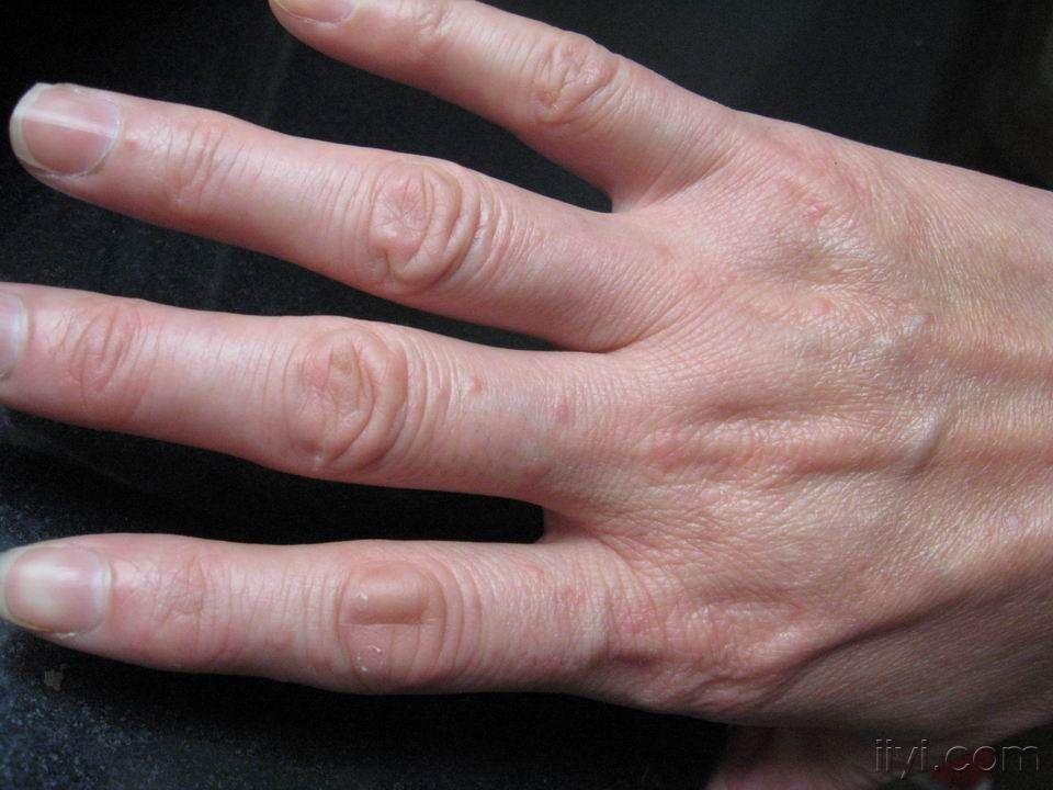双手反复红色丘疹伴瘙痒半年余(甲真菌病 接触性皮炎)