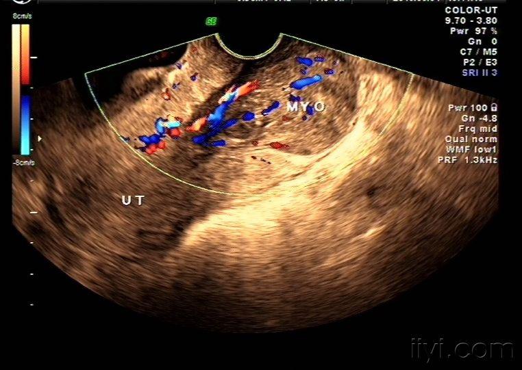 子宫颈黏膜下肌瘤声像图——zengerya - 超声医学讨论