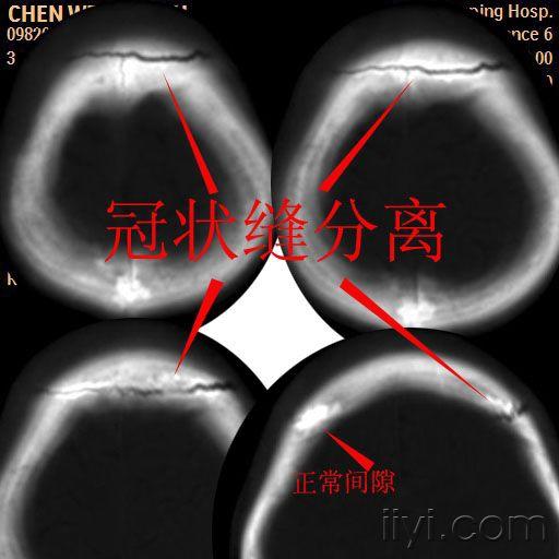 颅缝间隙>2mm,不对称,可以诊断颅缝分离.