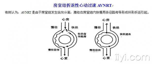 房室结折返性心动过速avnrt