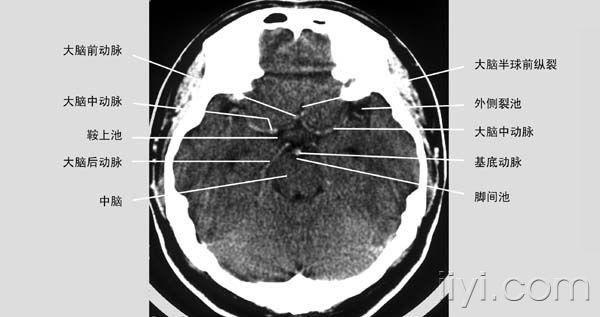 头颅ct的正常解剖