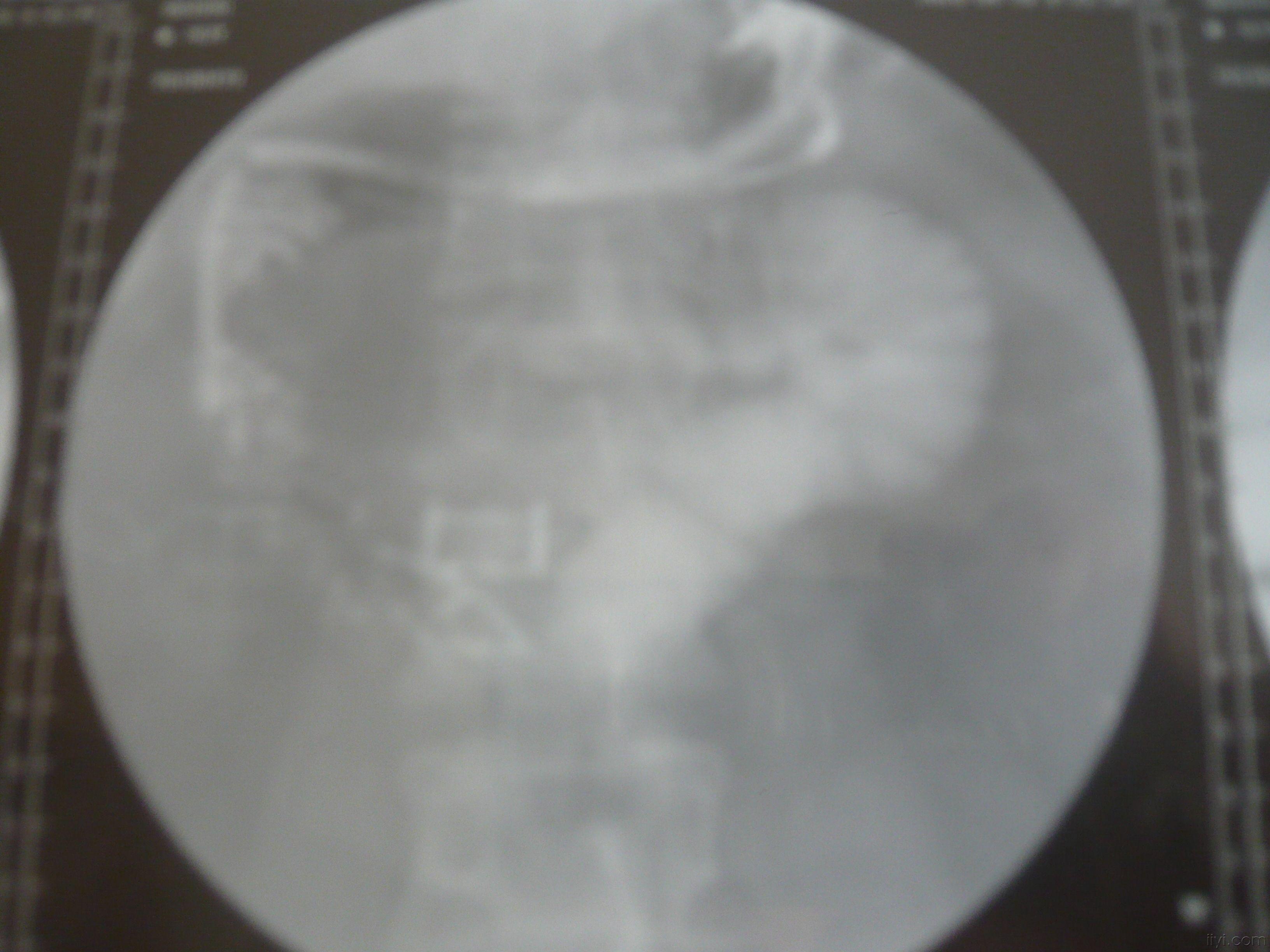 4月26日拔胸管前常规碘水造影食道癌术后复查:食道残端与胃于主动脉