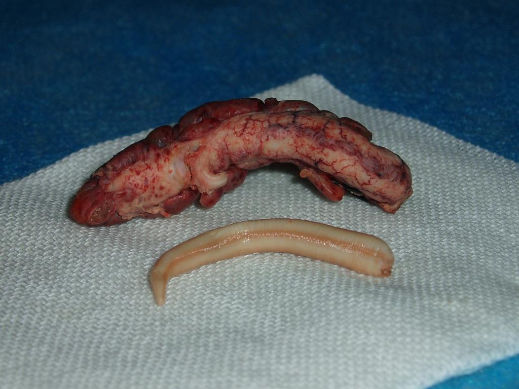 蛔虫性阑尾炎腹腔镜下手术致蛔虫残留体内