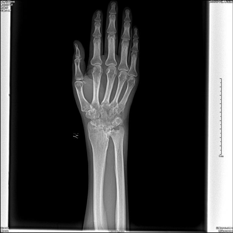 34我先说哈,这个病人是一个熟人带来的,她是2005年初觉得左手腕有点痛