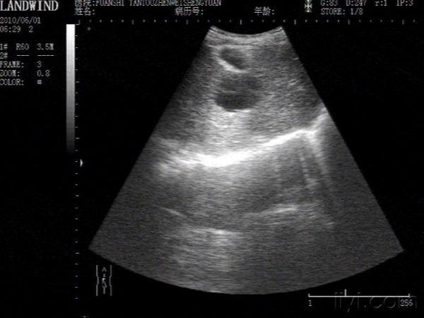 肝囊肿 超声医学讨论版 爱爱医医学论坛 爱爱医医学网
