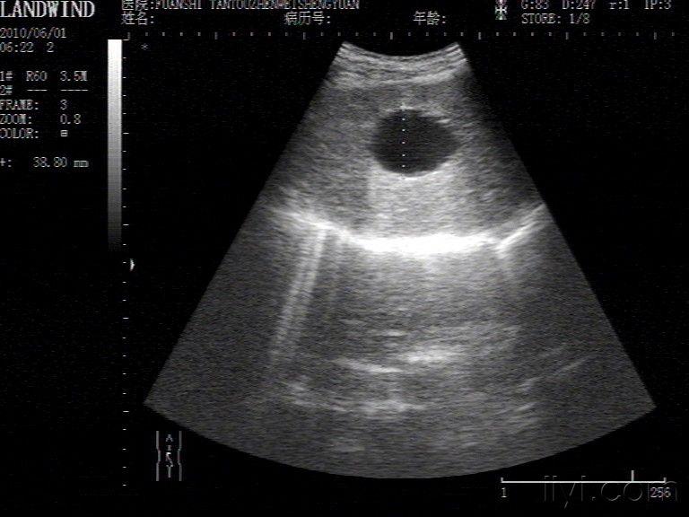 肝囊肿 超声医学讨论版 爱爱医医学论坛 爱爱医医学网