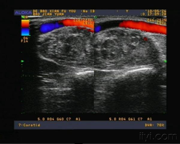 皮下肿块 - 超声医学讨论版 - 爱爱医医学论坛 - 爱爱