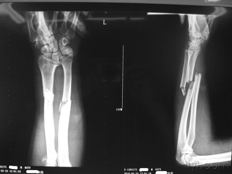 左前臂肘部骨折一例