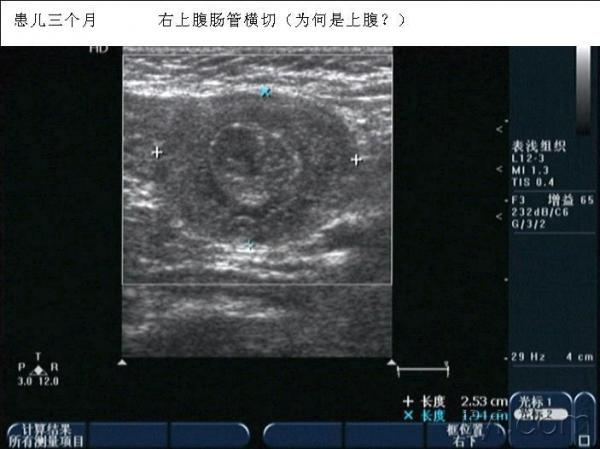 肠套叠内的淋巴结 - 超声医学讨论版 - 爱爱医医学