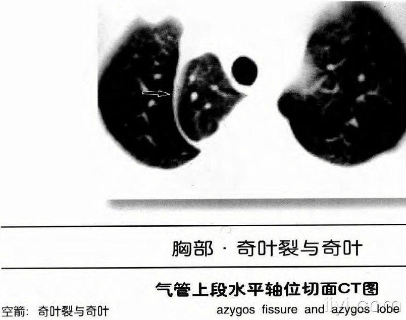 肺部ct图谱奇叶裂与奇叶 - 医学影像学资源版 - 爱爱