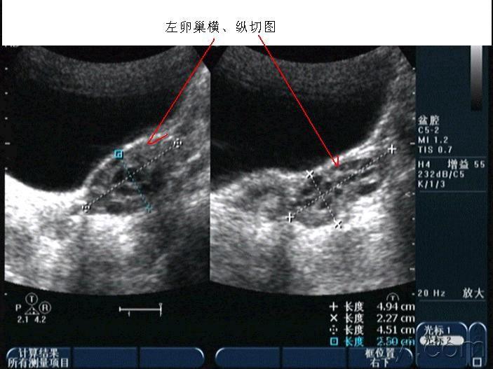 多囊卵巢? - 超声医学讨论版 - 爱爱医医学论坛 - 医