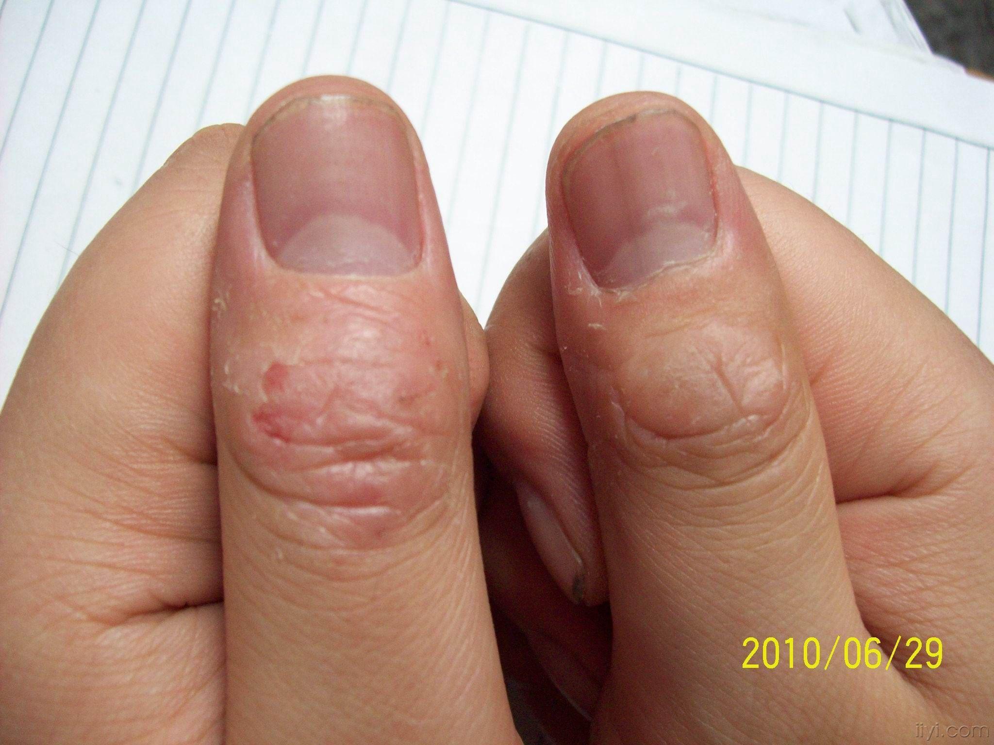 拇指第一关节皮肤角化是寄生虫感染,还是癣?