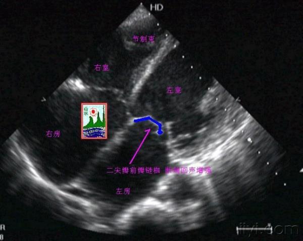 二尖瓣腱索断裂(补上一些图片 超声医学讨论版 爱爱医医学论坛