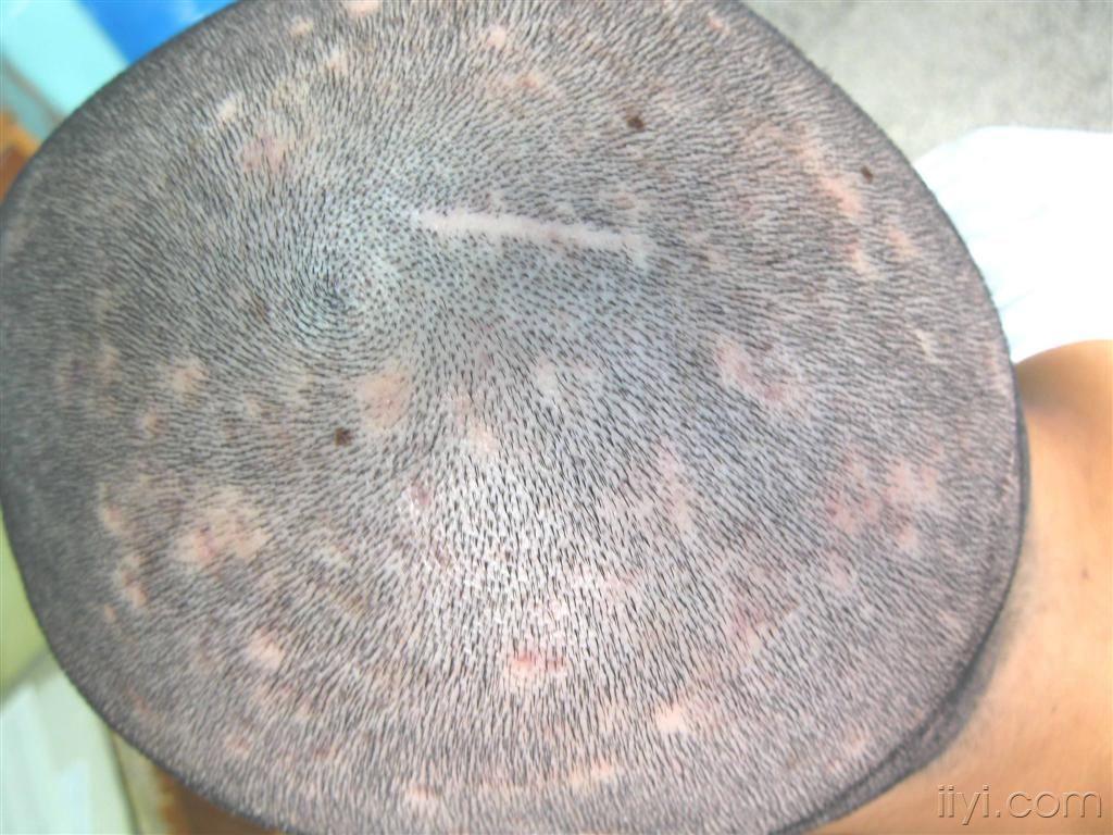 楼主wy啄木鸟2010-07-09 17:58:39头皮反复发作的毛囊炎,并伴脱发.