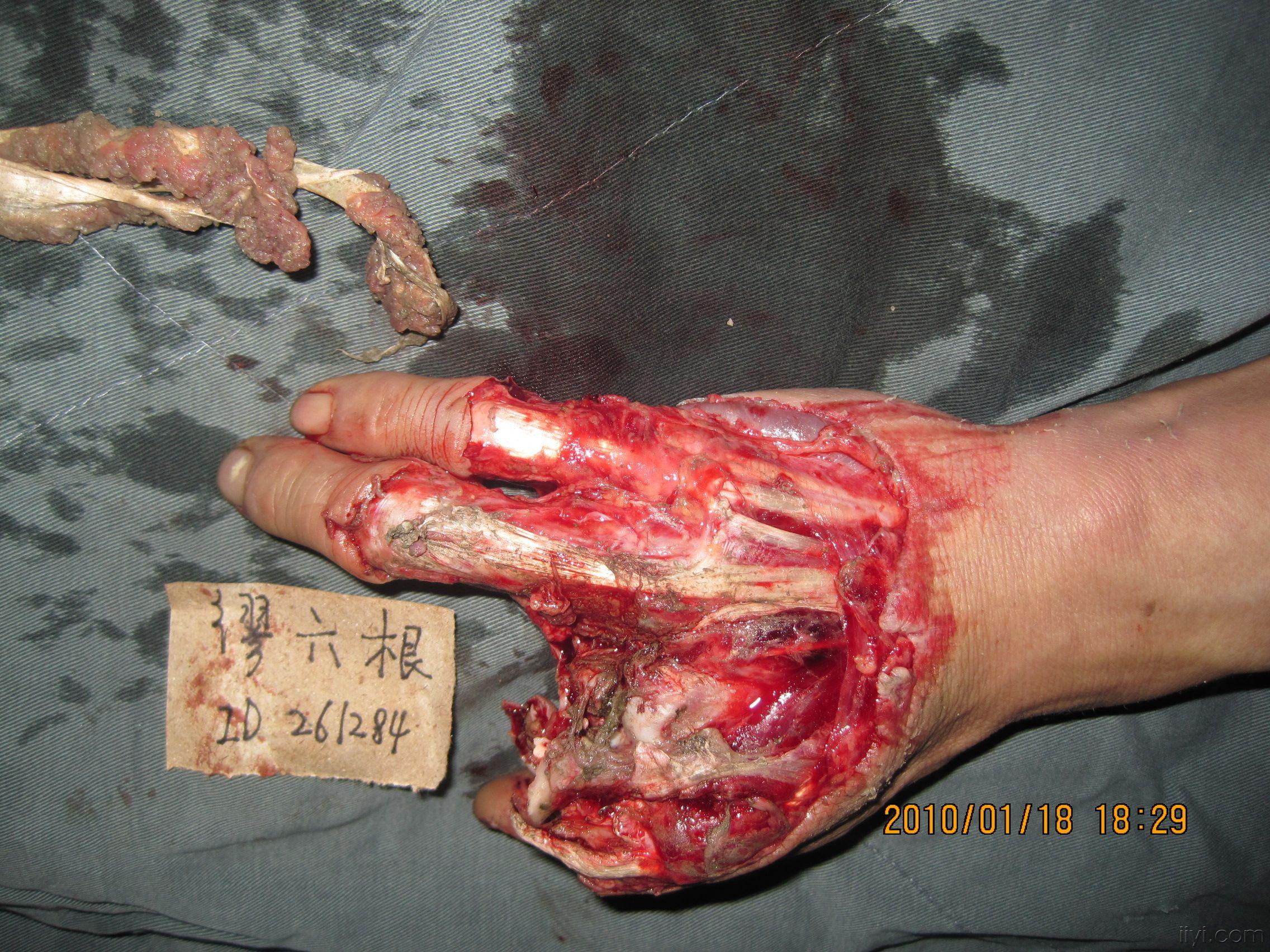 当时食指中指均予再植,中指掌指关节融合,食指深屈肌建接中指浅屈肌腱