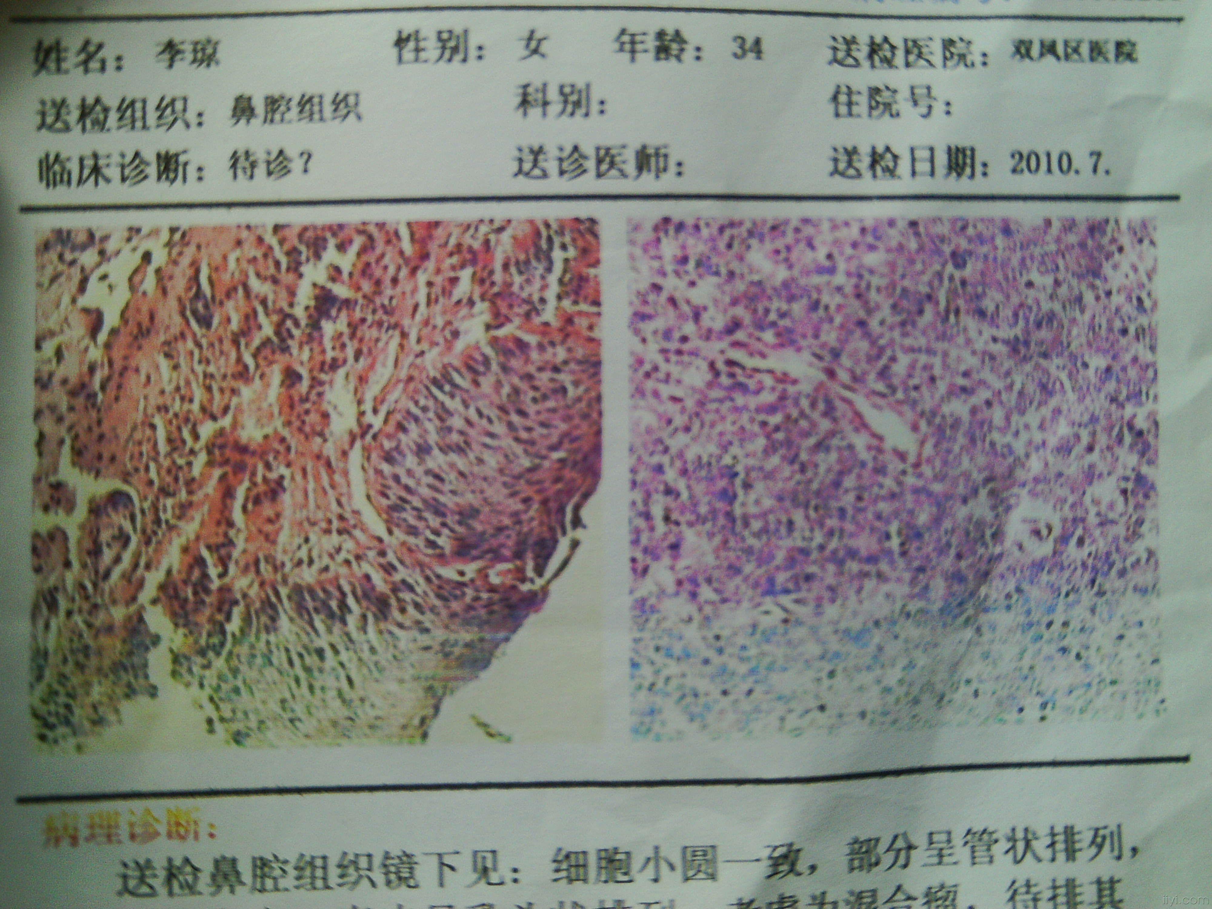 这是乳头状瘤还是.