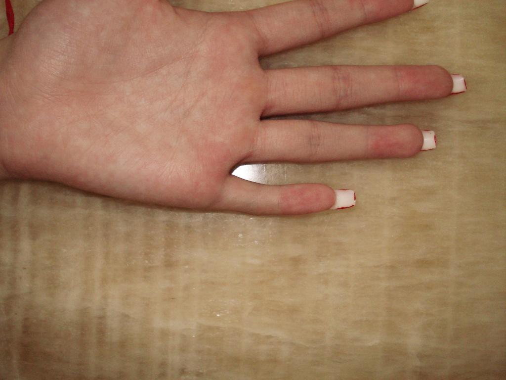 左小指近节指间关节屈曲畸形16年,请教治疗方案