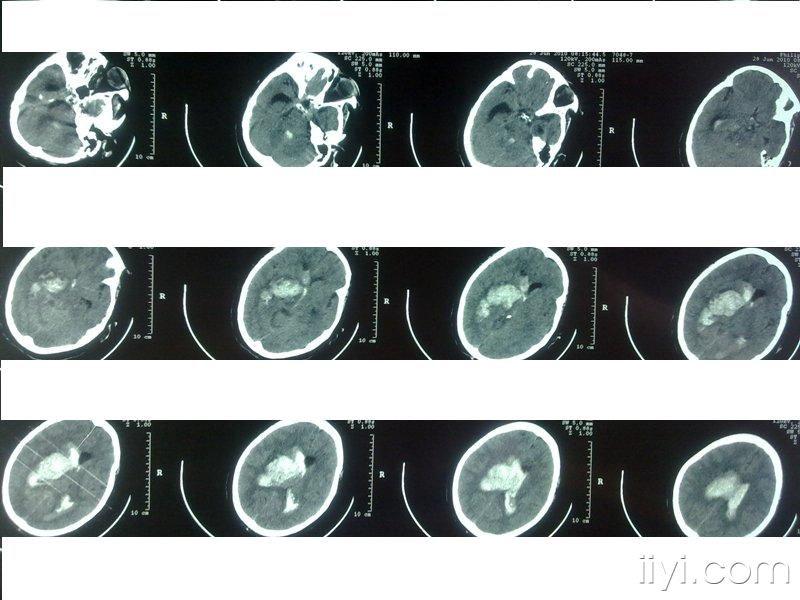 成功救治一例丘脑出血破入脑室,脑室铸型患者,与大家一起分享