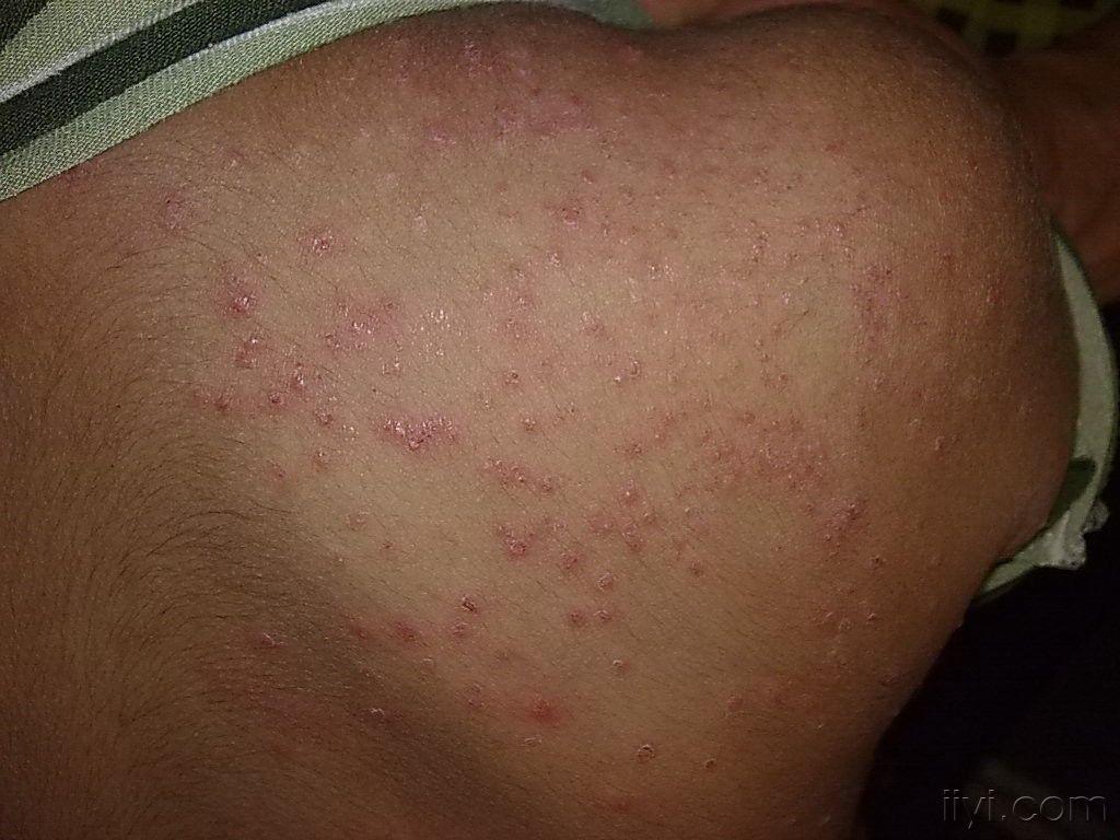皮肤霉菌病介绍 了解皮肤霉菌病的详细内容
