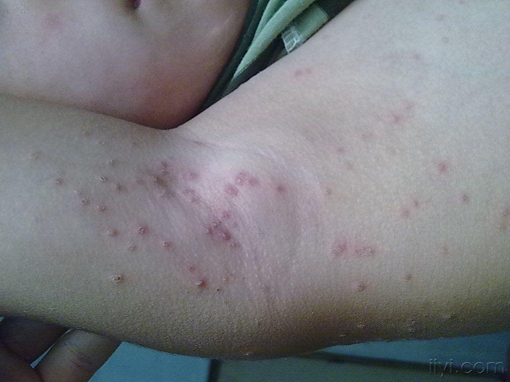 七八月份常见的皮肤病-丘疹型念珠菌病