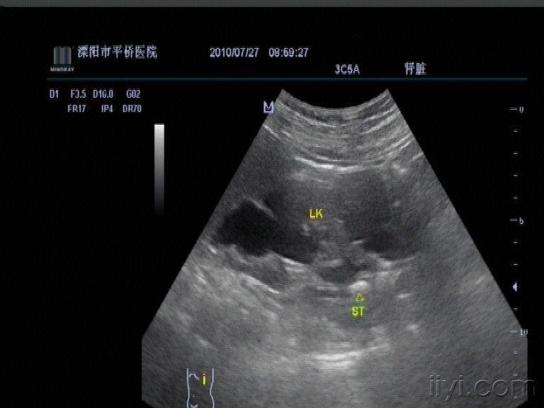 肾结石还是? - 超声医学讨论版 - 爱爱医医学论坛 - 爱爱医医学网