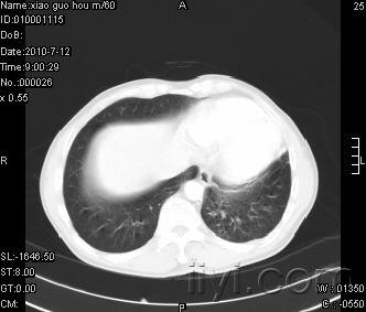 胸部正位片(x线)讨论