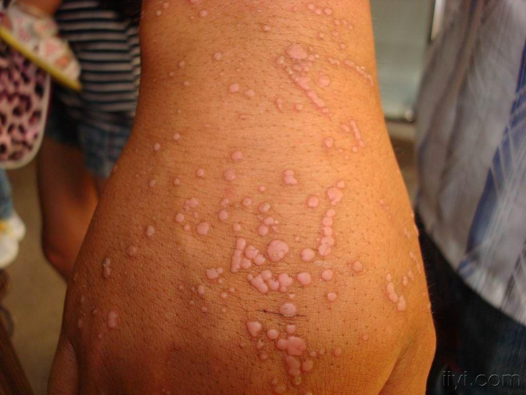 楼主海峰中医2010-08-02 21:02:51   今天接疹的一例疣状表皮发育不良