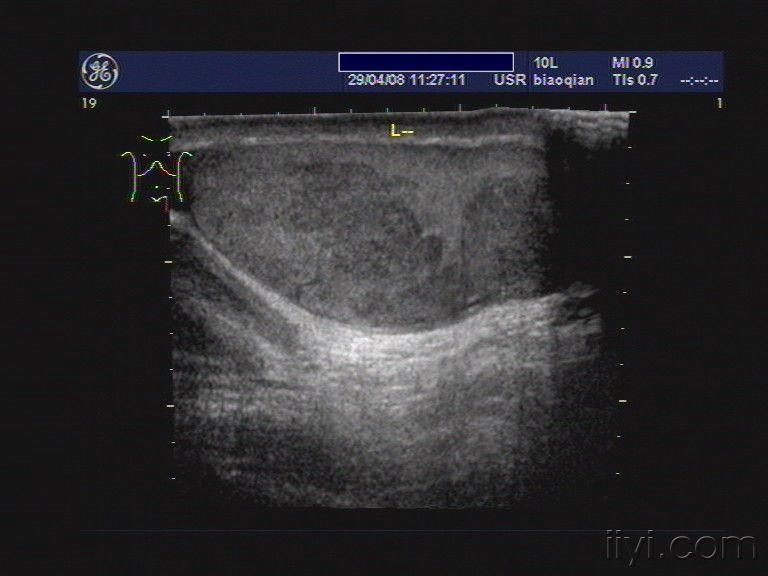 18:22:10   病史:患者男性,39岁,左侧阴囊肿大来就诊