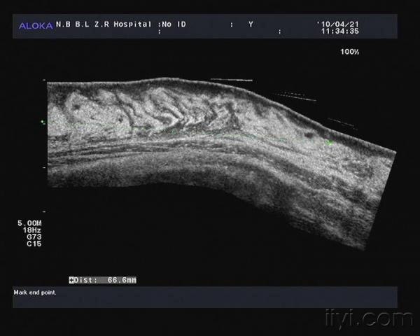 左胸壁神经纤维瘤 - 超声医学讨论版 - 爱爱医医学论坛 - 爱爱医医学