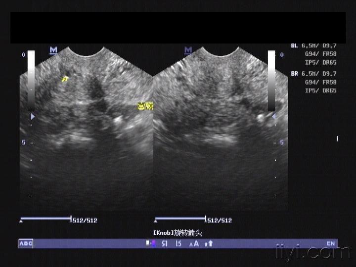 我报的是"双角子宫" - 超声医学讨论版 - 爱爱医医学