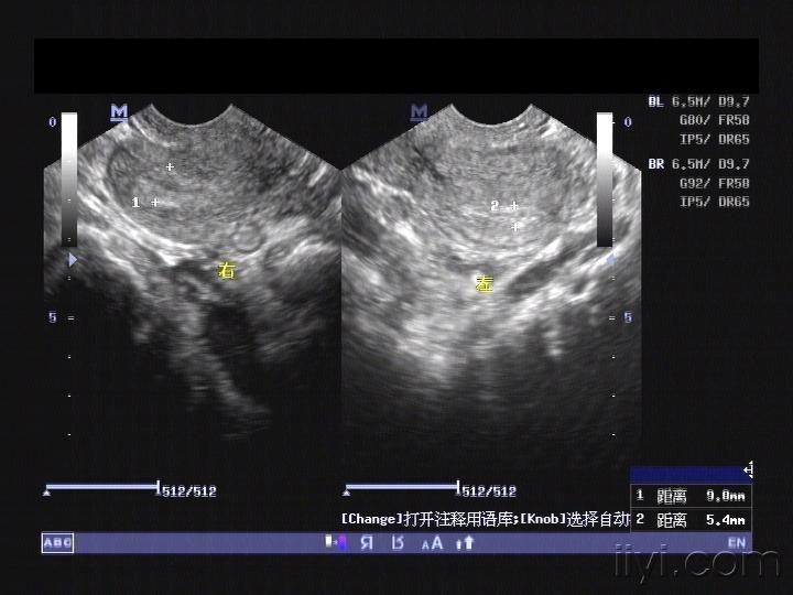 我报的是"双角子宫" - 超声医学讨论版 - 爱爱医医学