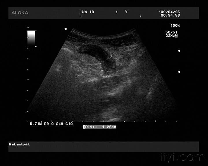 阑尾炎伴周围腹膜组织炎症 - 超声医学讨论版 - 爱爱
