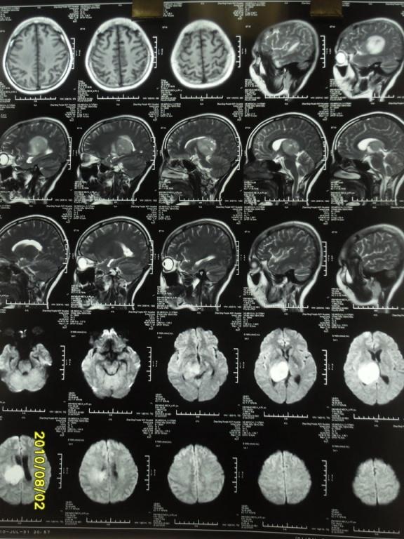 女,27岁,持续头痛一月余伴头晕,呕吐数天:脑胶质瘤?