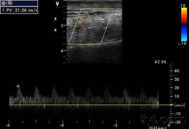 蔓状血管瘤 - 超声医学讨论版 - 爱爱医医学论坛 - 医