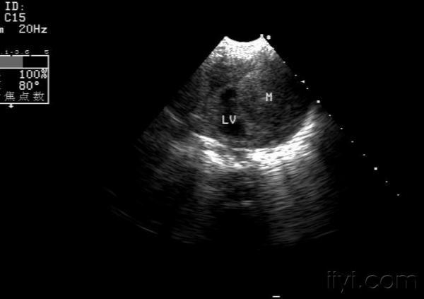 左心室实性包块——左室横纹肌瘤