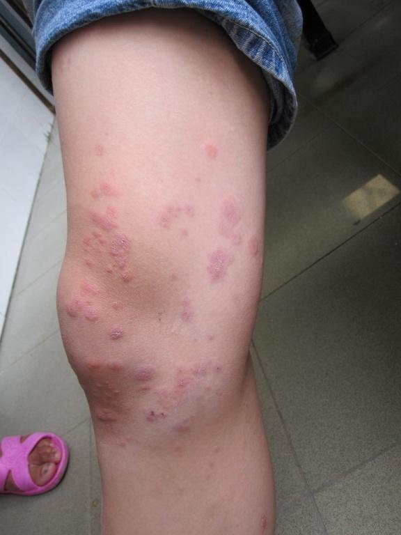 看图识病1-公布答案:单纯疱疹导致的复发性多形红斑