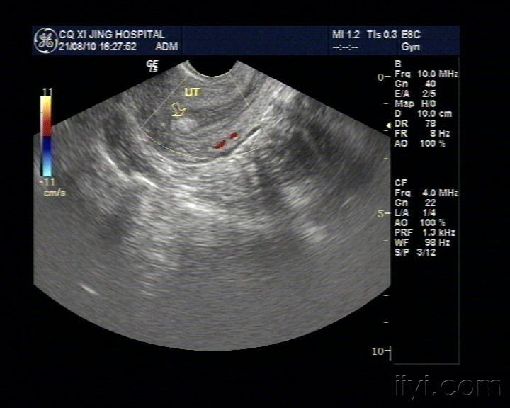 子宫内膜里的增强回声 超声医学讨论版 爱爱医医学论坛 爱爱医